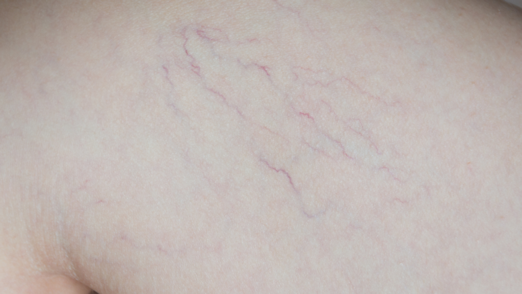 PENGOBATAN VENA SPIDER & TELANGIECTASIA