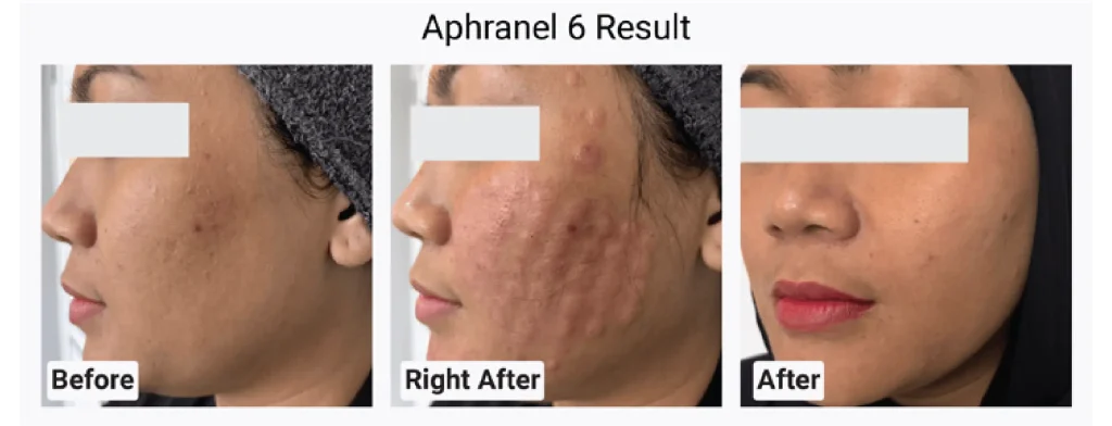 aphranel before after