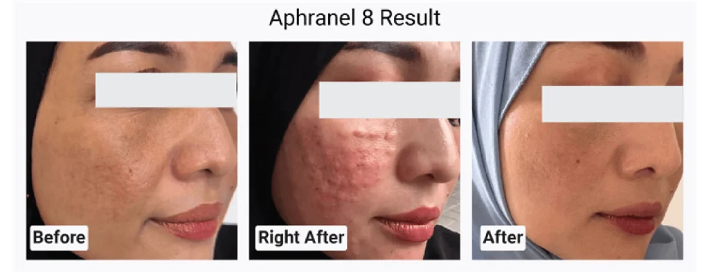aphranel before after2